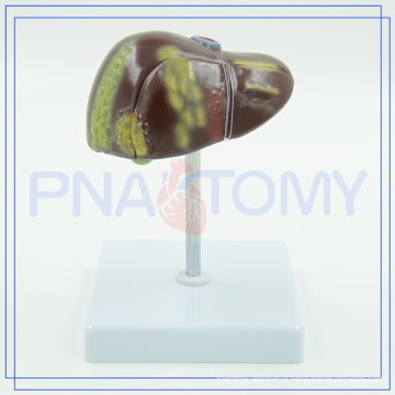 PNT-0752 human liver cirrhosis model for medical use